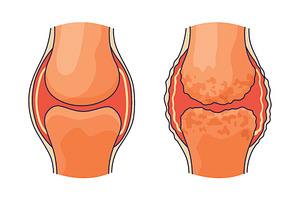 Rheumatoid arthritis. A