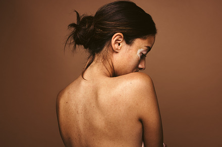 Portrait of woman with skin condition, a Person Photo by Jacob Lund