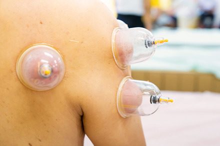 Close up for multiple vacuum cups, medical cupping therapy on hu