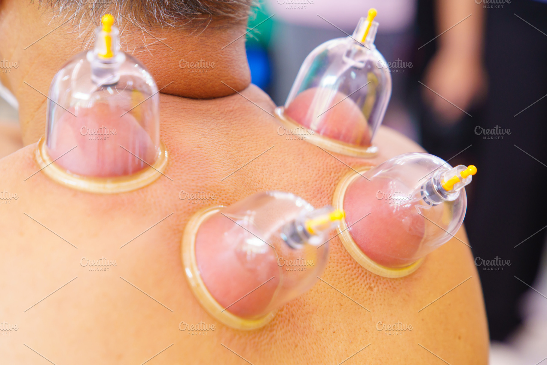 Close up for multiple vacuum cups, medical cupping therapy on hu, a Health & Medical Photo by Casanowe-studio