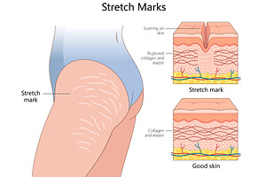 Stretch Marks with Skin Structure, a Healthcare Illustration by AlexArt