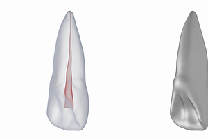 Upper Central Incisor With Pulp