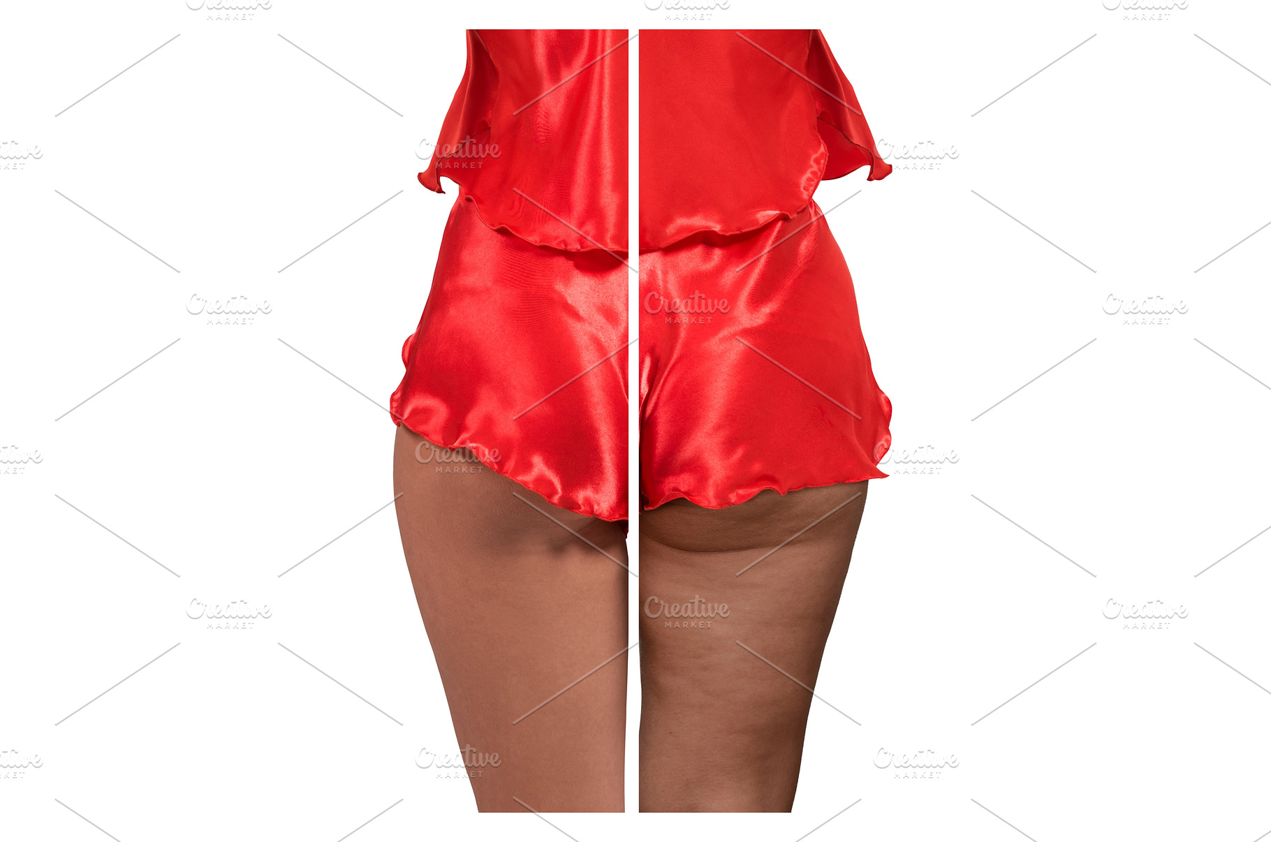 Woman's thighs and buttocks with, a Health & Medical Photo by Jan Jack Russo Media