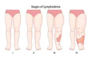 Lymphedema Stages in Legs structure, a Healthcare Illustration by AlexArt