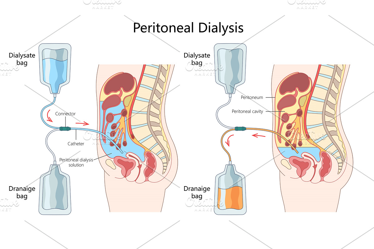 Peritoneal Dialysis Process medical, a Healthcare Illustration by AlexArt