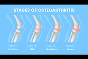 Knee joint osteoarthritis stages, a Healthcare Illustration by Seavector Studio (Thumbnail 1 of 3)