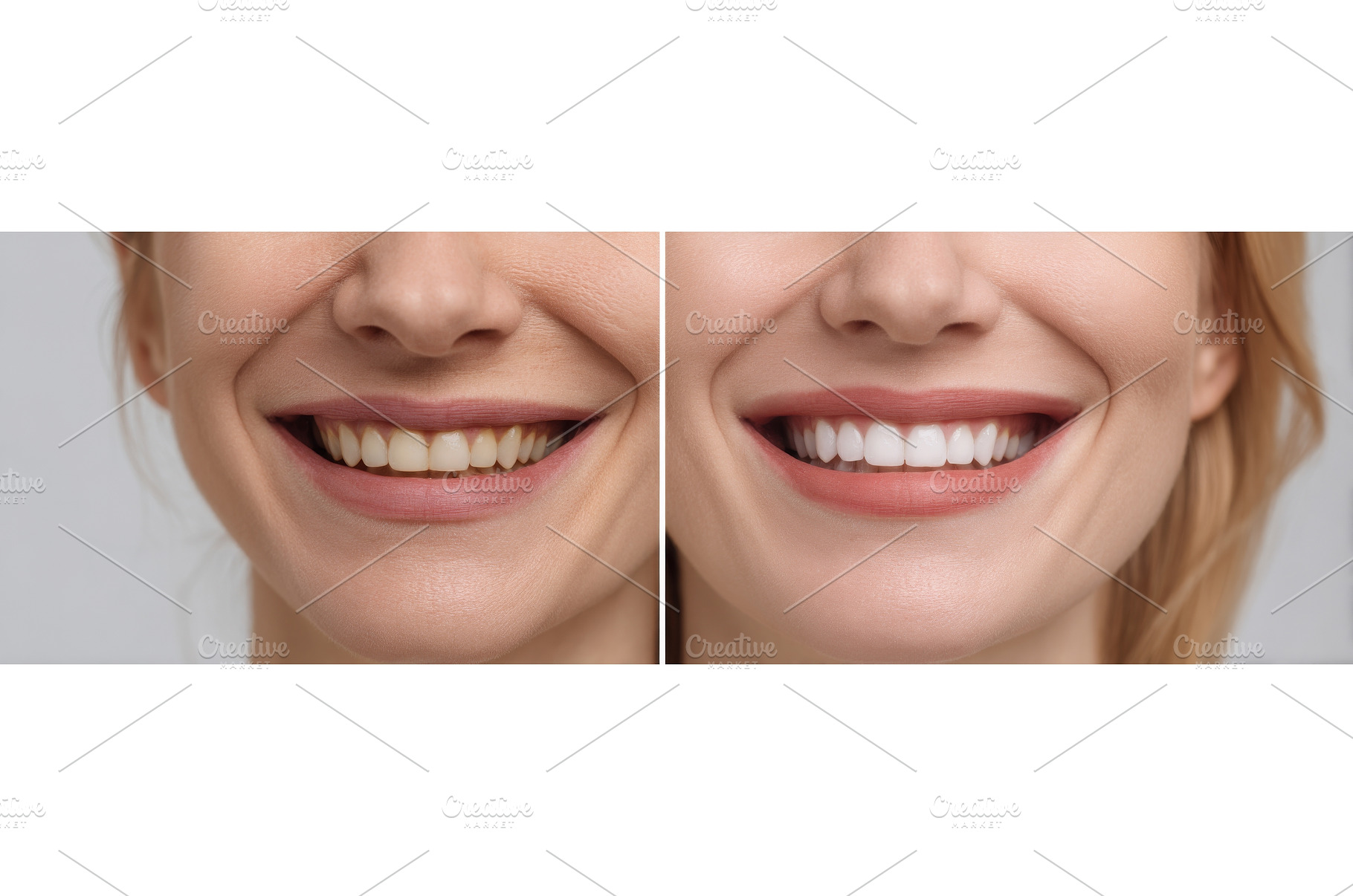 A woman's teeth are shown before and, a Person Photo by ZinetroN