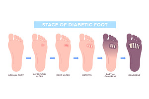 Diabetic foot. Various stages of, an Object Illustration by LadadikArt