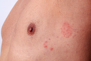 close-up of shingles on the chest of a man, a Photo by Nito