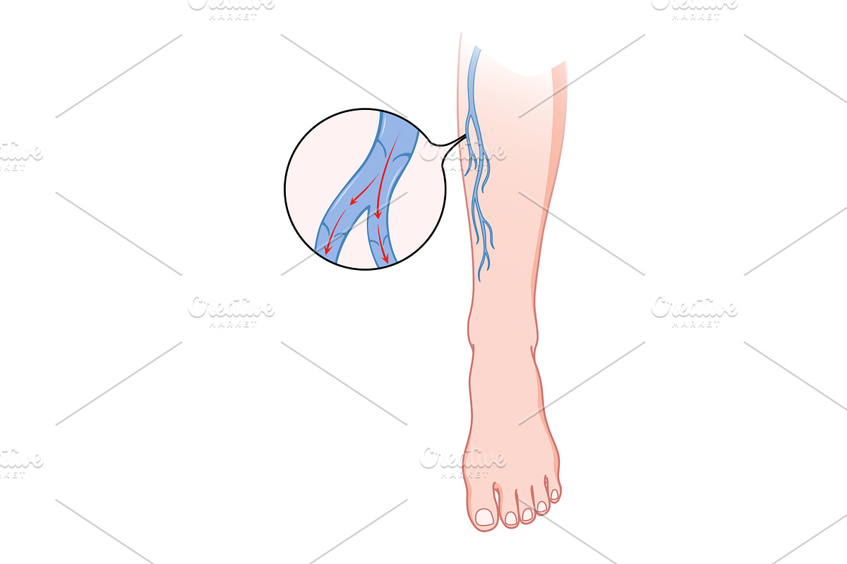 Varicose veins. Blue blood, an Object Illustration by Things for designers