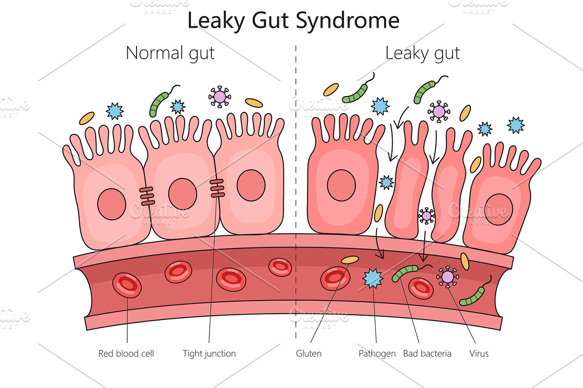 Leaky Gut Syndrome structure medical, an Object Illustration by AlexArt