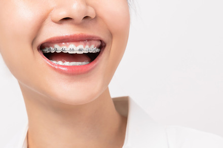 Face of a young smiling asian woman stock photo containing brace and dentist