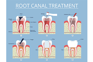 Root canal treatment stages. Dental, an Object Illustration by YummyBuum
