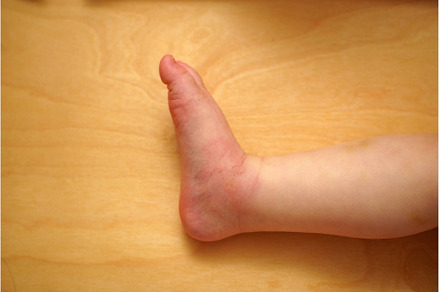 A child leg shows noticeable redness