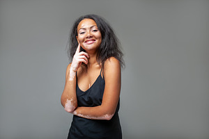 Happy fashion model with vitiligo standing against gray background, a Photo by andreonegin market
