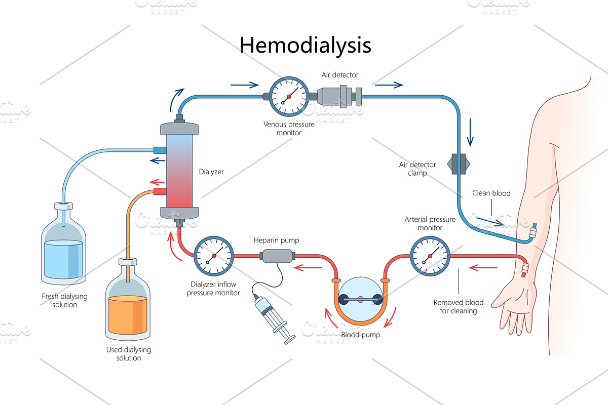 Hemodialysis Blood Cleaning Process, a Healthcare Illustration by AlexArt