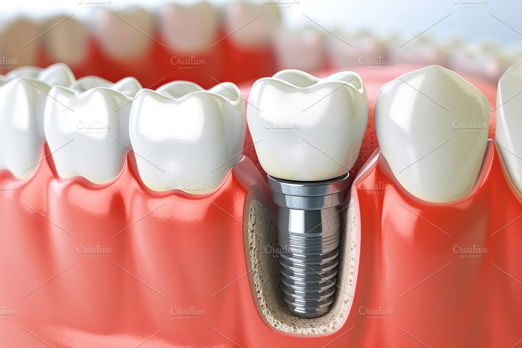 Illustration of human jaw with dental tooth implant. 3D rendering, a Health & Medical Photo by AlyaAnd