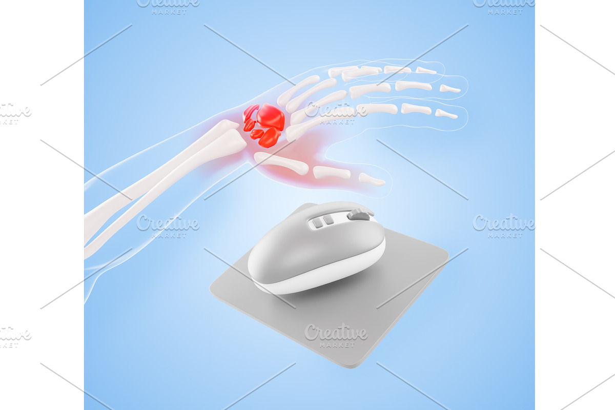 Carpal tunnel syndrome concept. 3D, a Healthcare Illustration by Marozhkastudio