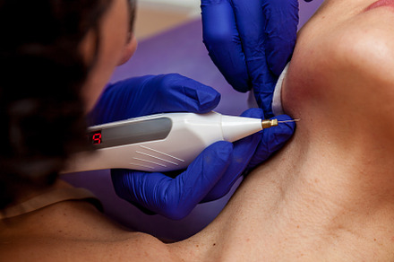 Removal of papillomas on the body, a Health & Medical Photo by Photostock