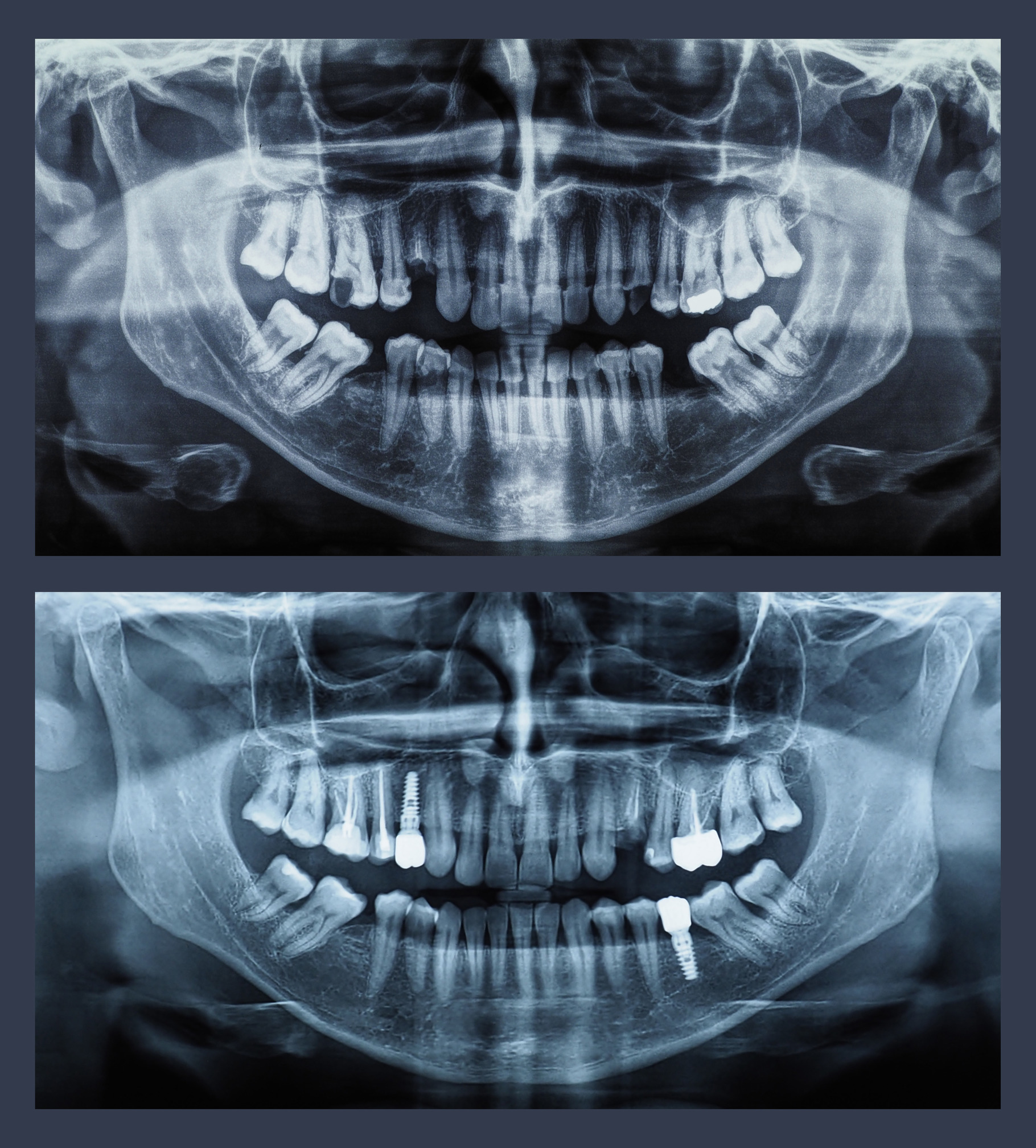 orthopantomograph panoramic image radiograph of teeth, a Photo by ...