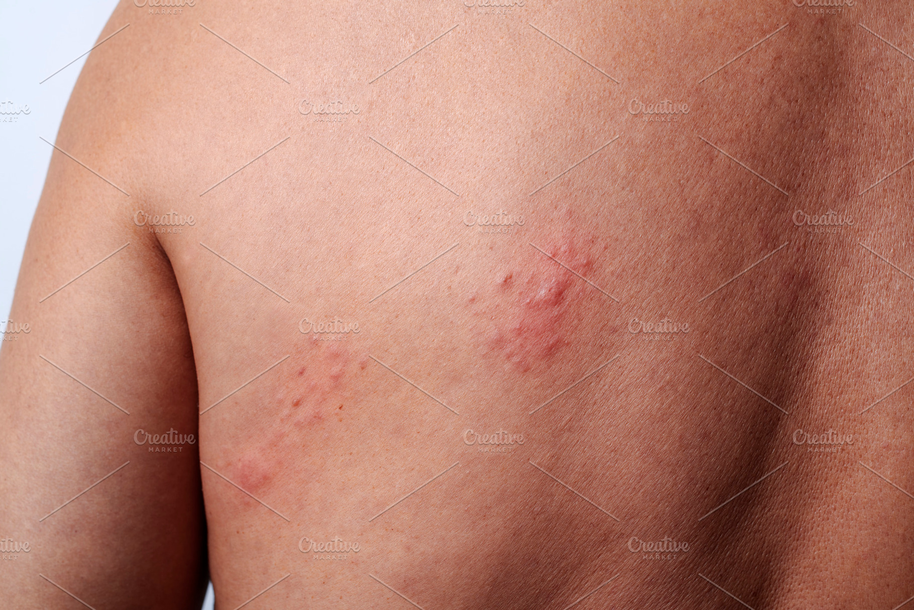shingles outbreak on the upper back of a man, a Photo by Nito