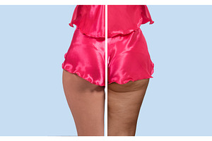 Before and After Cellulite, a Health & Medical Photo by Jan Jack Russo Media