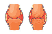 Rheumatoid arthritis. A, an Object Illustration by Things for designers (Thumbnail 1 of 3)