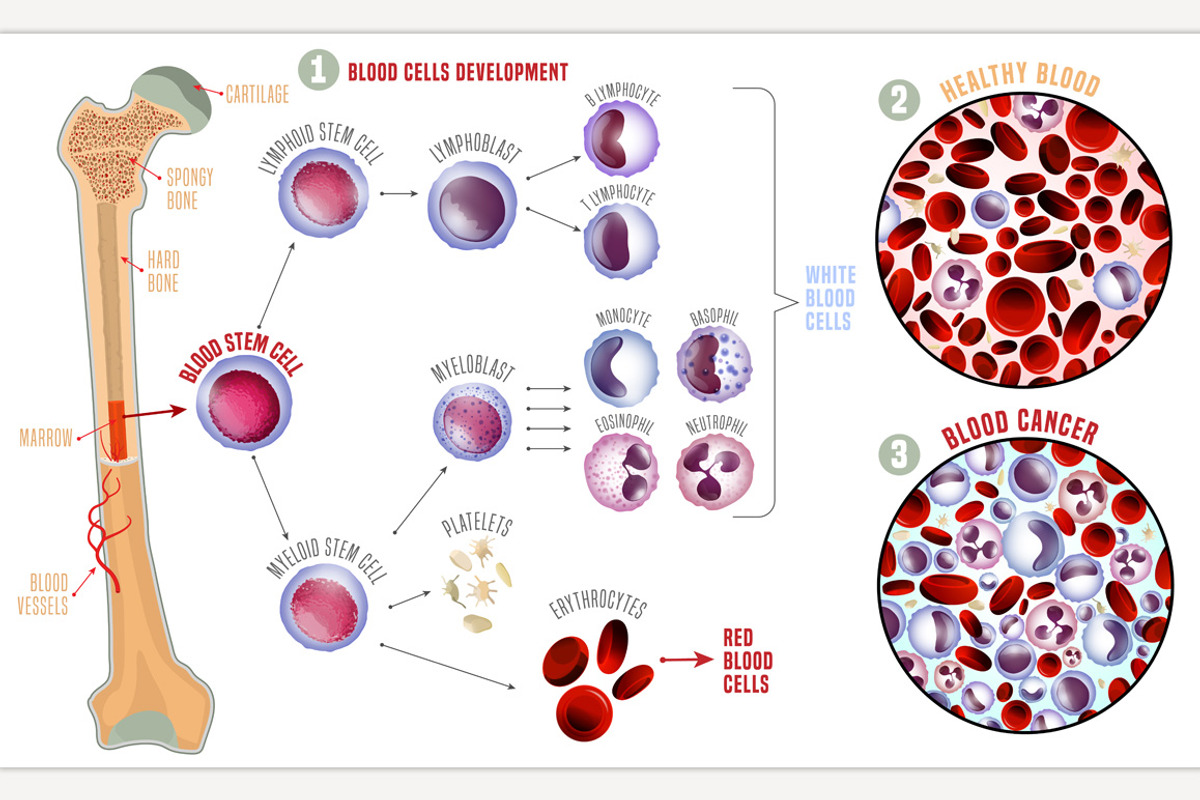 Leukemia medical infographic, a Healthcare Illustration by Anna's Shop