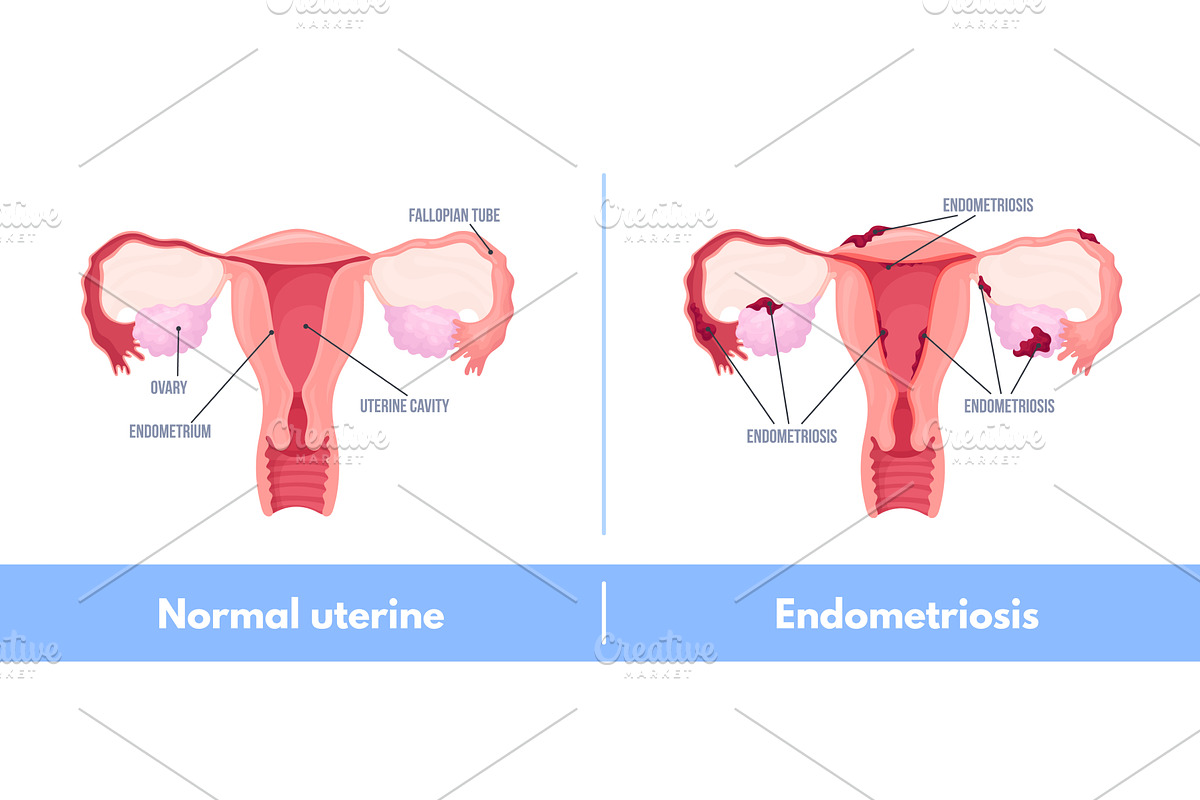 Endometriosis. Female uterus, an Object Illustration by Stock-Smart-Start