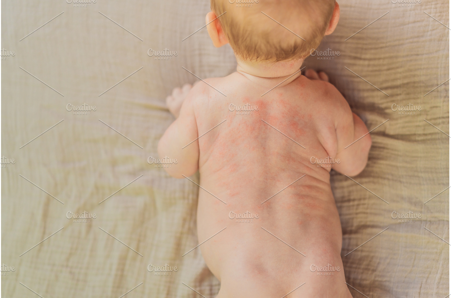 Severe heat rash on newborn baby, a Health & Medical Photo by Elizaveta Galitskaya