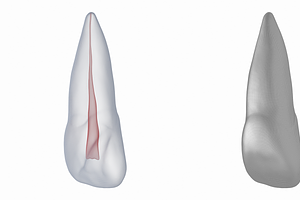 Upper Central Incisor With Pulp