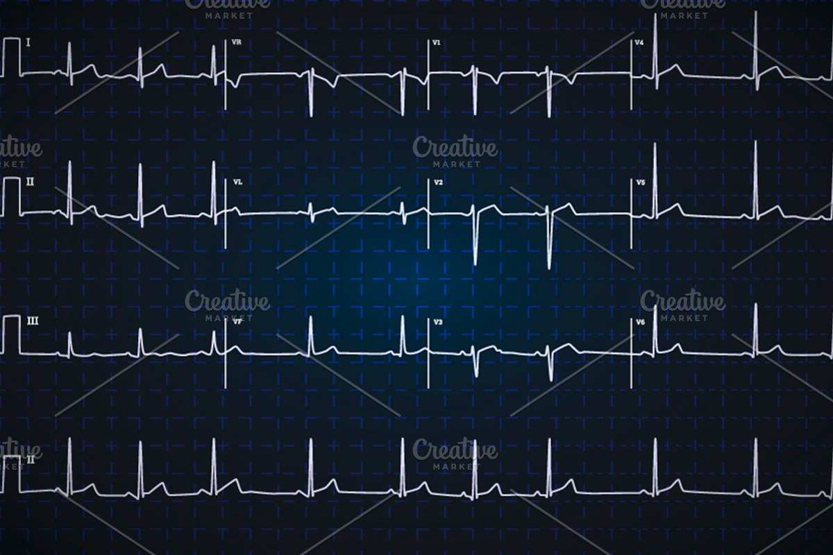 Electrocardiogram graph on dark blue, a Healthcare Illustration by BestPics