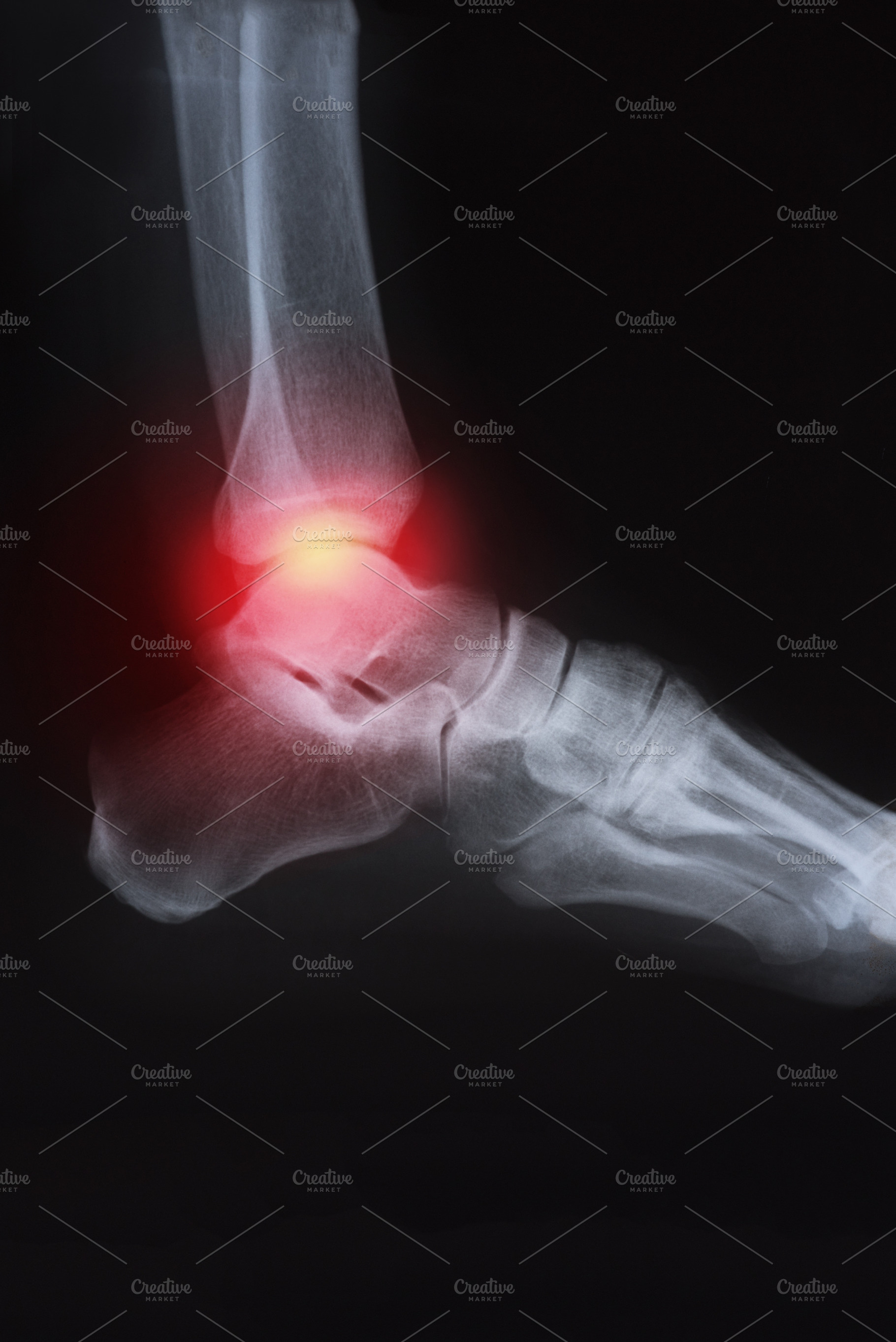 Medical xray knee joint image with featuring arthritis, anatomy, and pain, a Health & Medical Photo by david.herraez.calzad