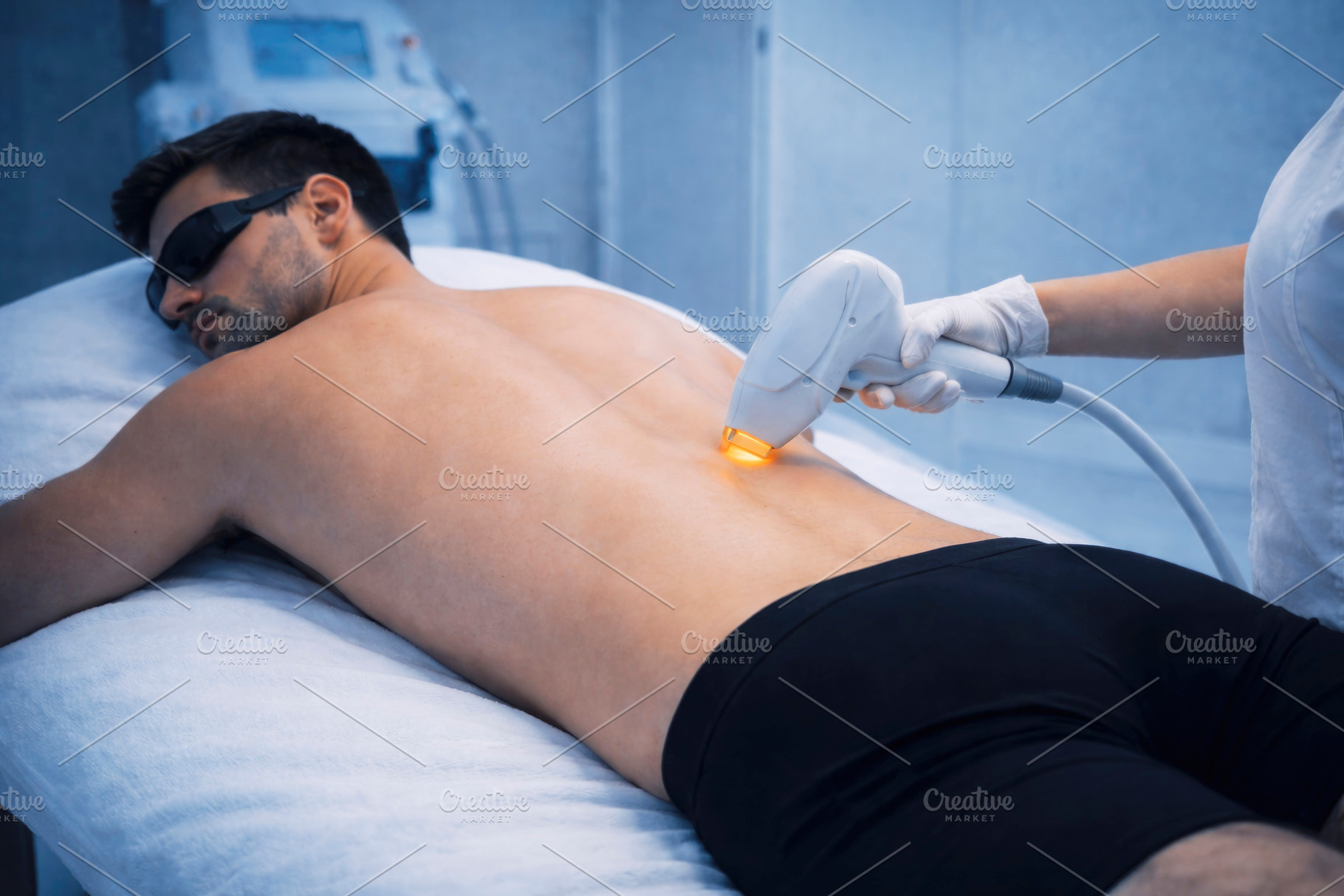 having laser hair removal on back, generative AI, a Photo by Nito