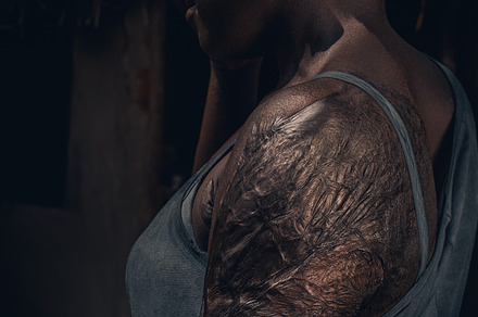 African Burn Victim