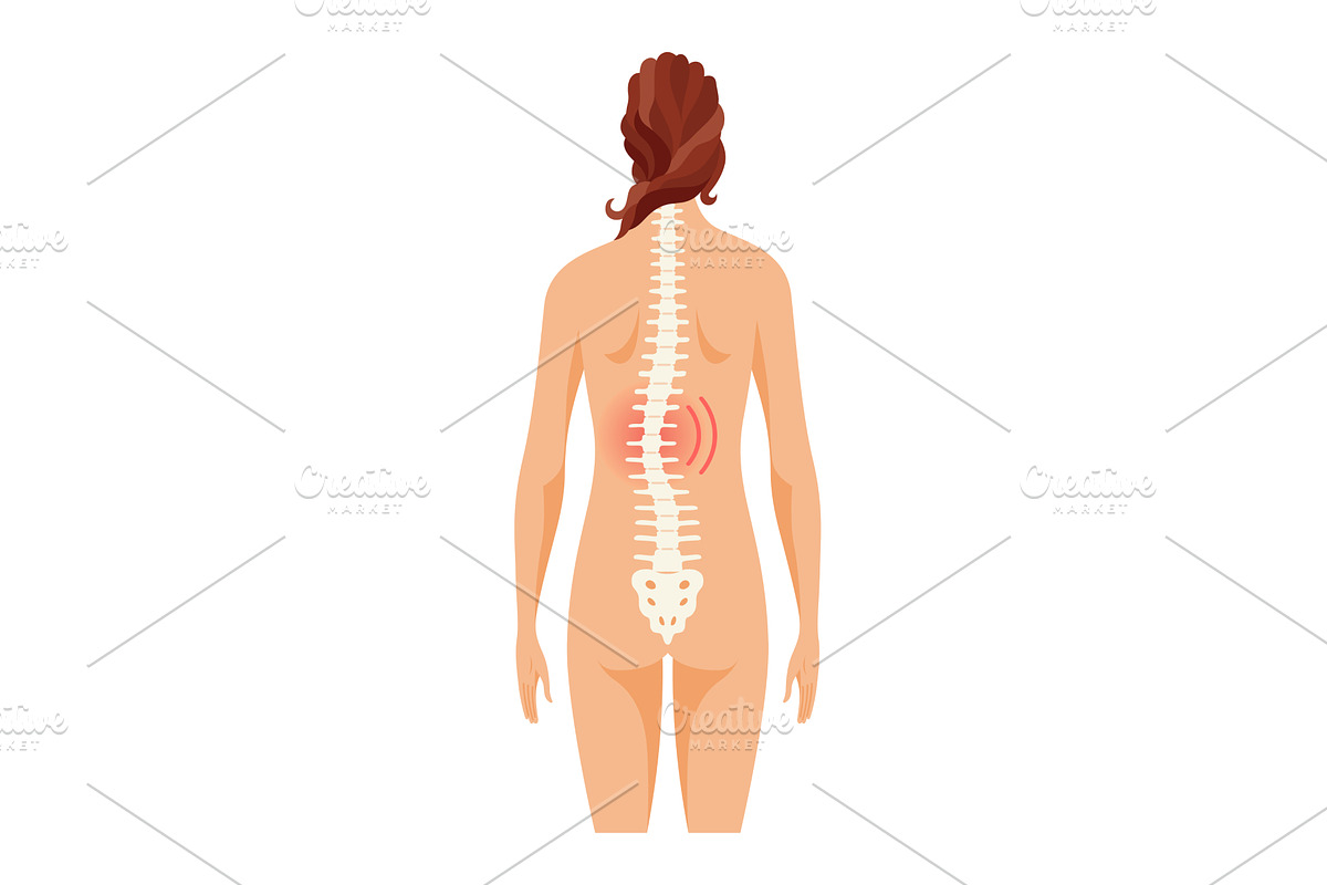 Scoliosis affecting, an Object Illustration by Things for designers