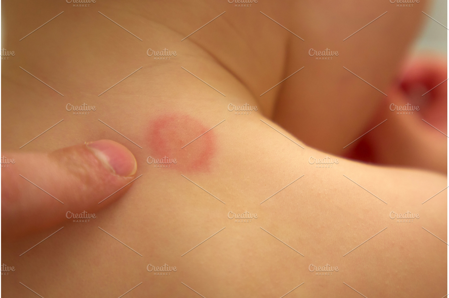 Mosquito bite on child back in a, an Architecture Photo by darksoul72