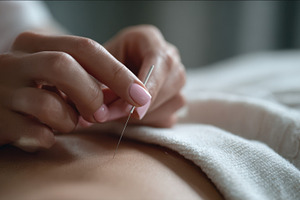 Acupuncture therapy session, a Photo by Beautiful things