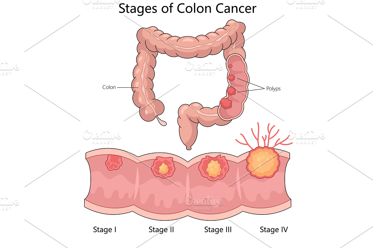 Colon Cancer Stages diagram medical, a Healthcare Illustration by AlexArt