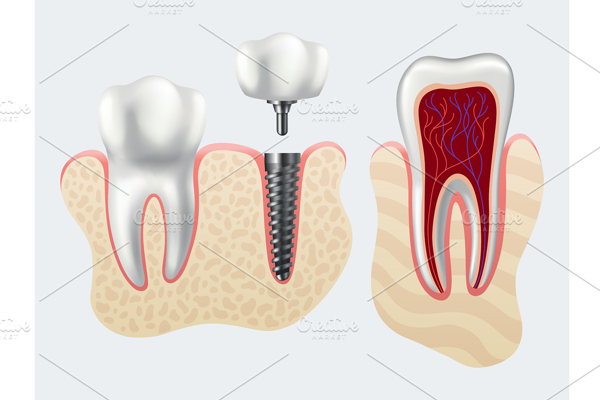 Dental implant structure. Medical, an Object Illustration by the8monkey