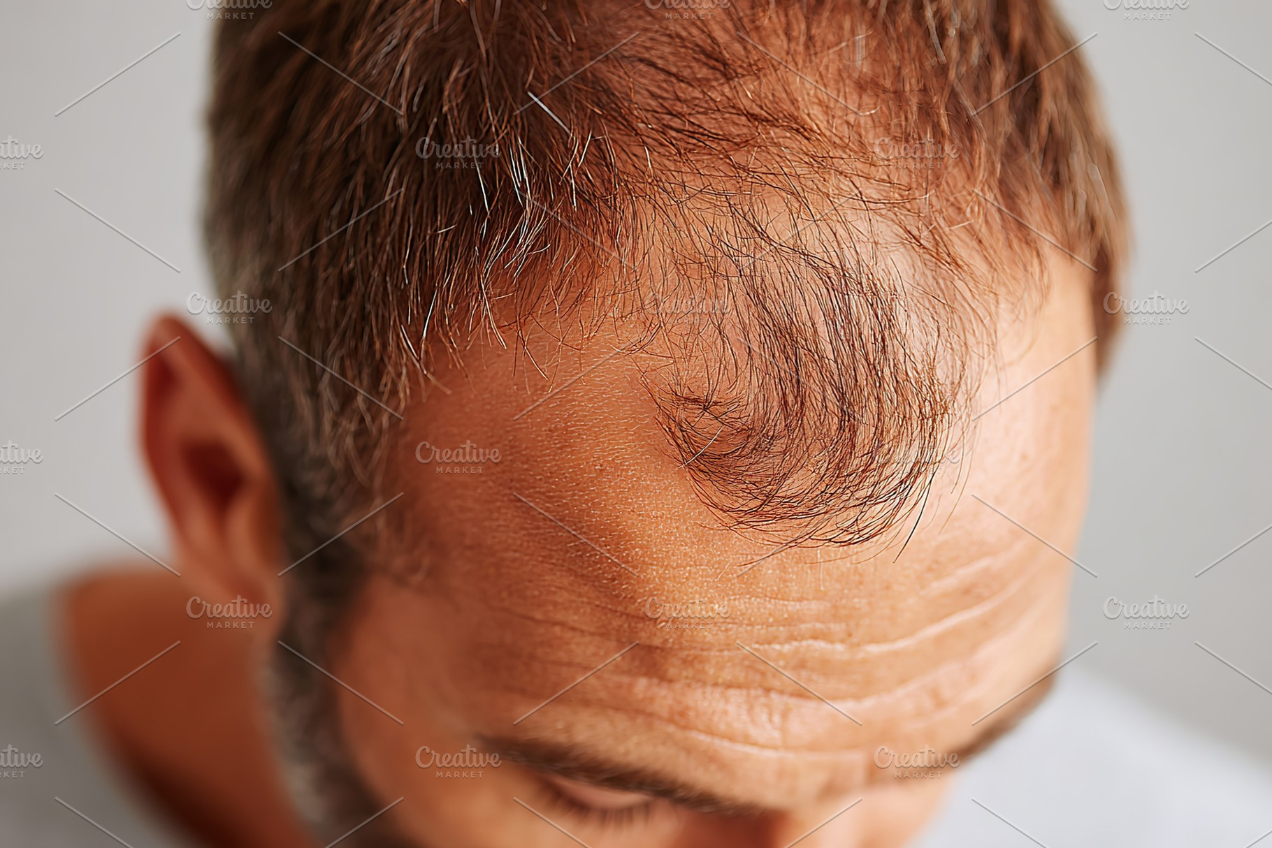 Close-up view of a man's scalp with thinning hair in a neutral setting, a Person Photo by AlyaAnd