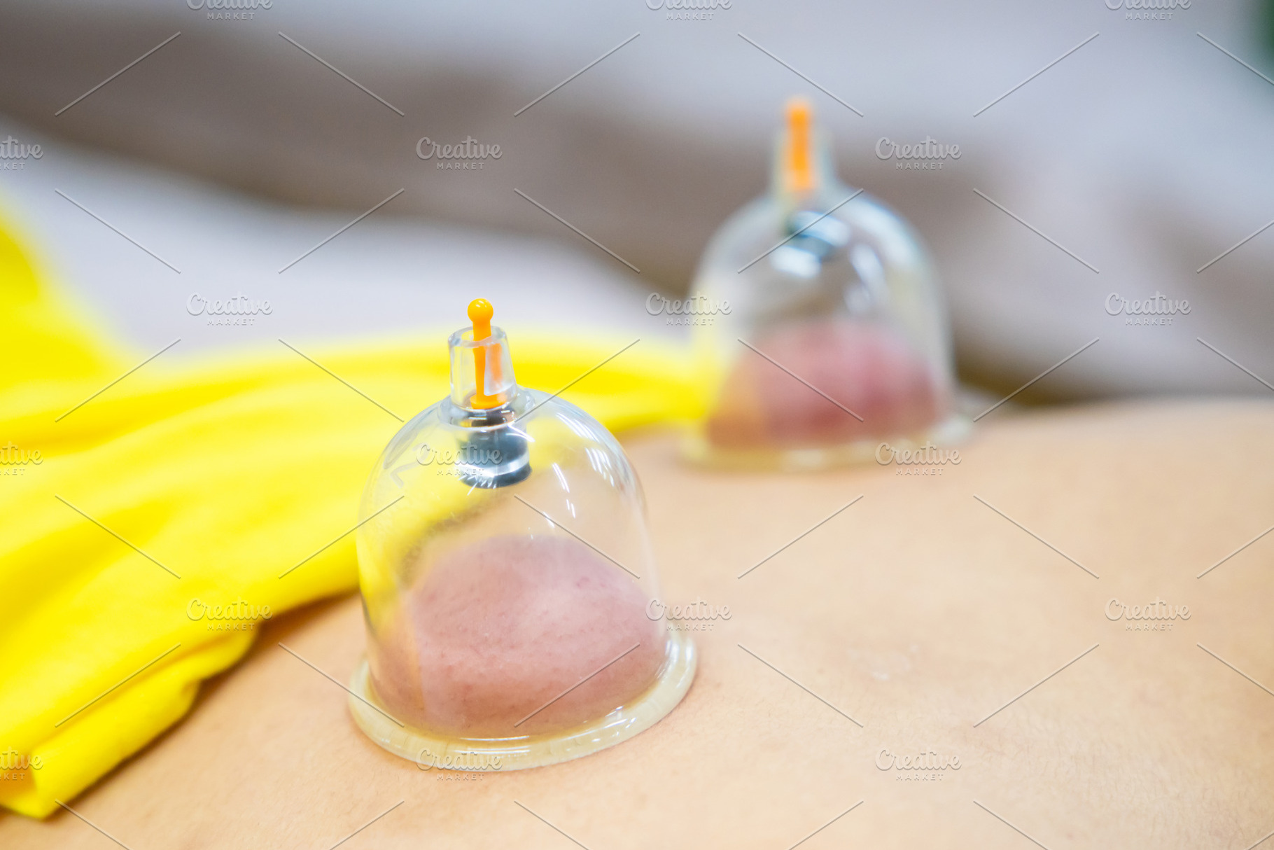 Close up for multiple vacuum cups, medical cupping therapy on hu, a Photo by Casanowe-studio