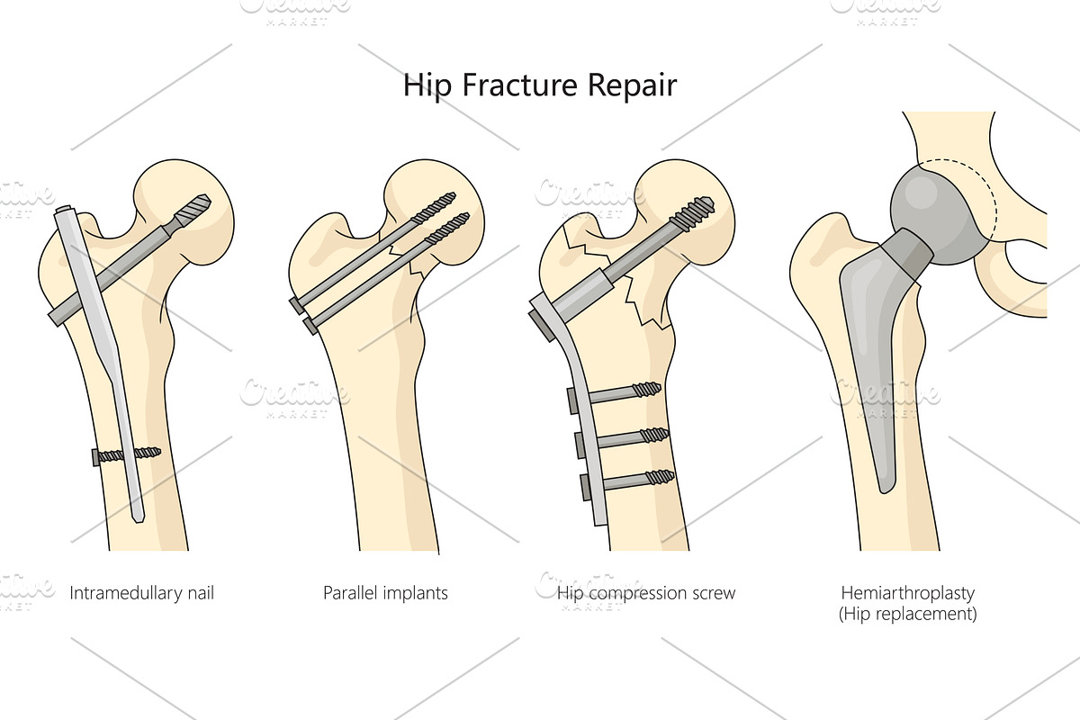 hip fracture treatment diagram medic, a Healthcare Illustration by AlexArt