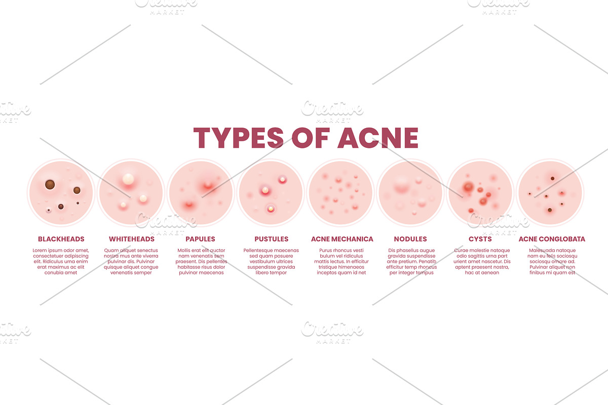 Body skin acne type pore, a Healthcare Illustration by Vector Tradition