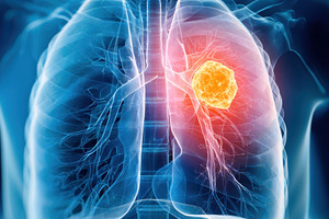 Anatomical illustration of lungs with highlighted tumor, a Health & Medical Photo by AlyaAnd