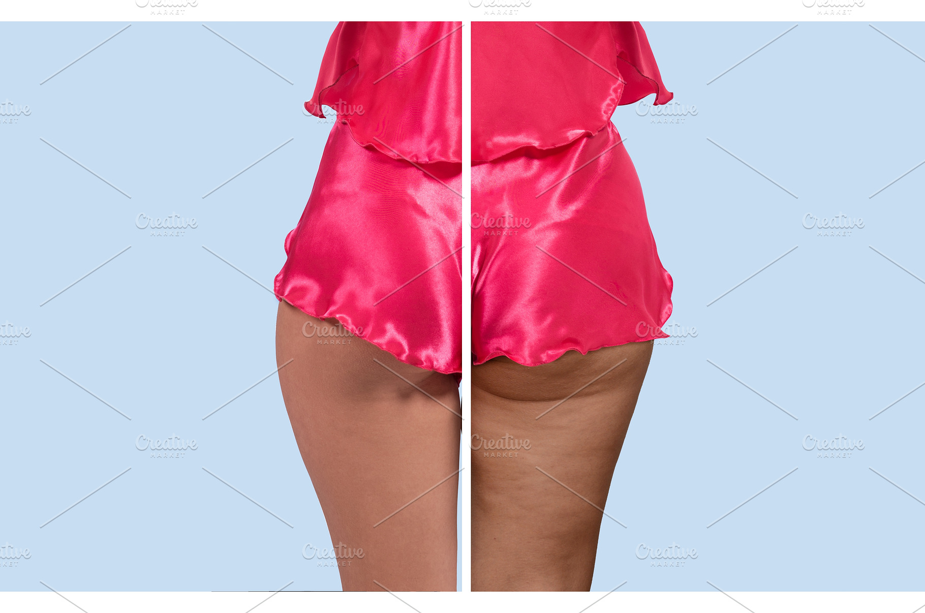 Before and After Cellulite, a Health & Medical Photo by Jan Jack Russo Media