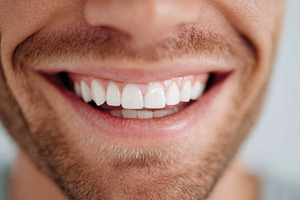 Beautiful white teeth after whitening comparison, a Health & Medical Photo by AlyaAnd