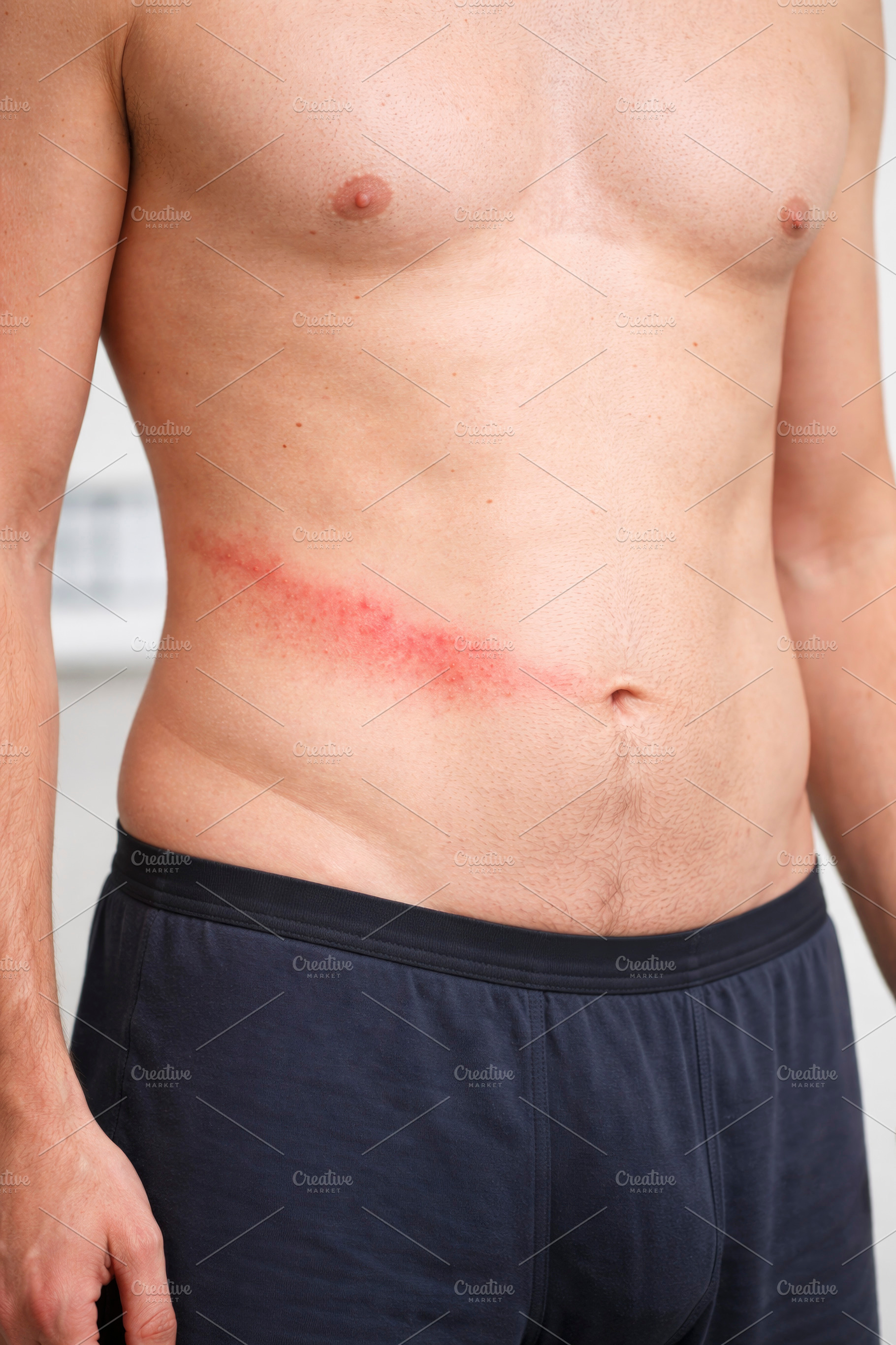 man standing with herpes zoster, generative AI, a Photo by Nito