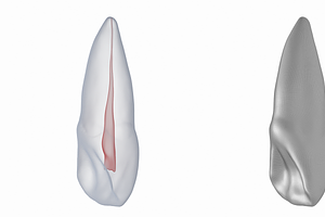 Upper Central Incisor With Pulp