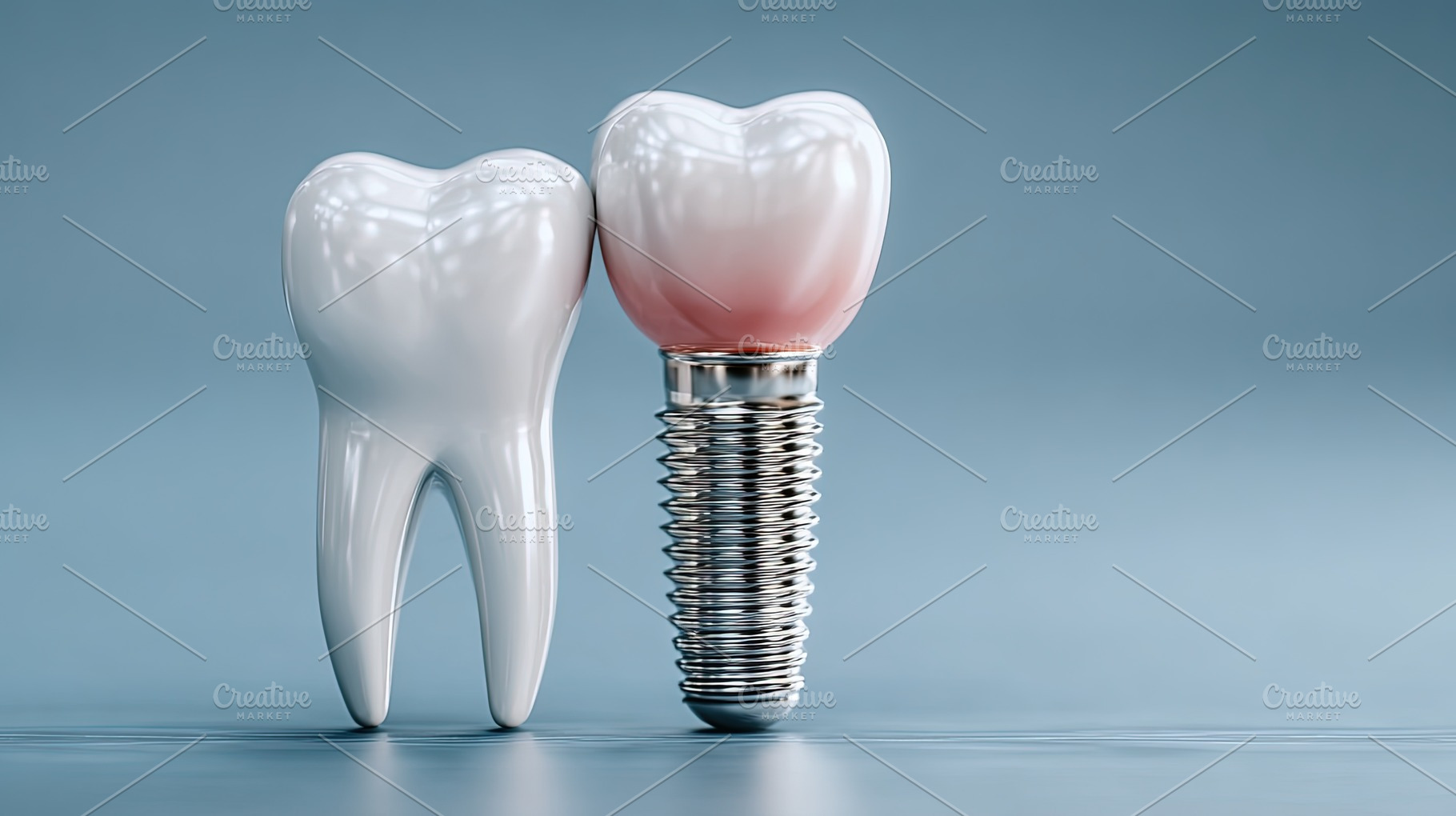 Dental Implant and Natural Tooth, a Health & Medical Photo by Ales Munt
